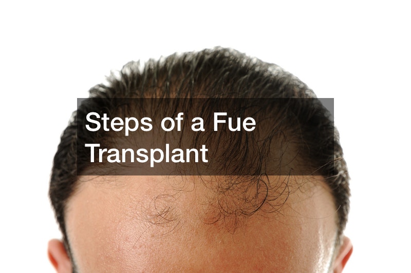 Steps of a Fue Transplant